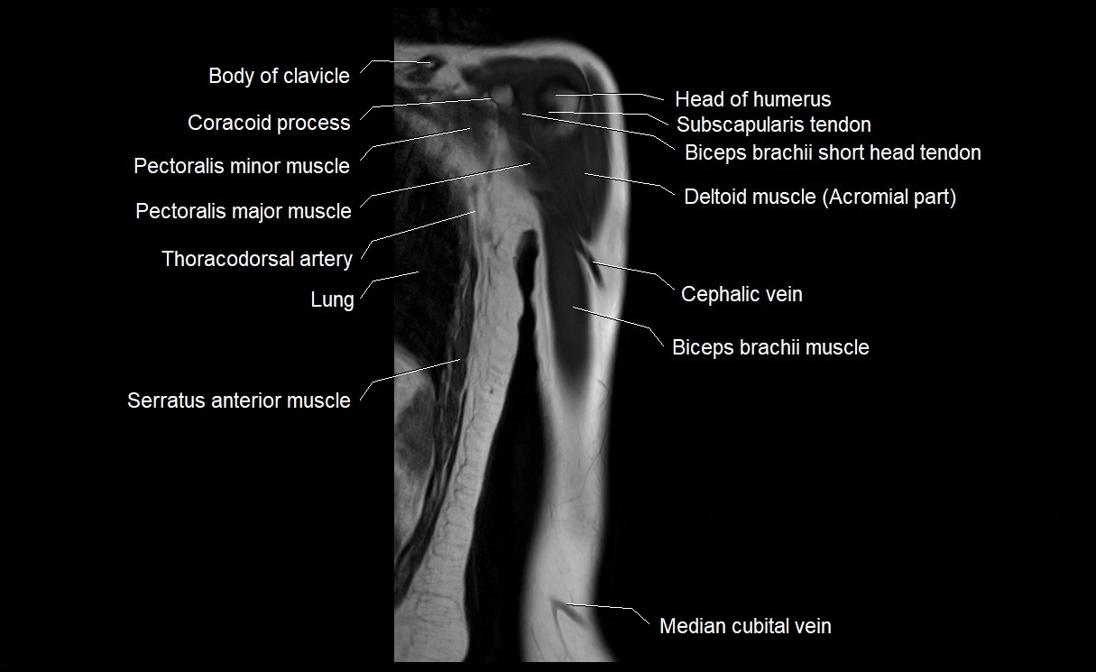 MRI upper arm (humerus ) coronal cross sectional anatomy image 5.webp